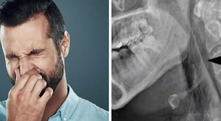 the horrible consequence of stopping a sneeze is a hole in the trachea